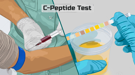 نحوه انجام آزمایش پپتید سی تست پپتید سی, آزمایش C-Peptide, C-Peptide در آزمایش خون