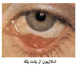 شالازیون, درمان شالازیون, گل‌مژه چیست