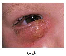 شالازیون, درمان شالازیون, گل‌مژه چیست