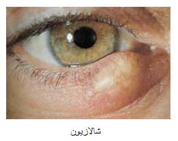 شالازیون, درمان شالازیون, گل‌مژه چیست