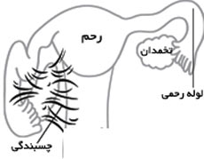 چسبندگی رحم,علائم چسبندگی رحم,نشانه های چسبندگی رحم