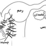چسبندگی رحم,علائم چسبندگی رحم,نشانه های چسبندگی رحم