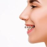 دیپ بایت, درمان دیپ بایت دندان, دیپ بایت به عنوان اپن بایت قدامی نیز شناخته می شود
