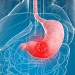 علائم سرطان معده چیست, علائم اولیه سرطان معده