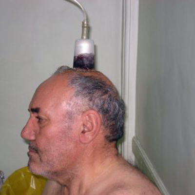 مضرات و فواید حجامت سر, حجامت سر چیست