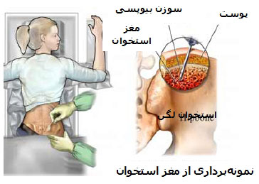 علل سرطان استخوان، بیماری سرطان استخوان درد سرطان استخوان, علایم سرطان استخوان در خون