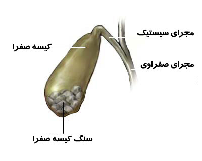  کله سیستیت, عوارض کله سیستیت