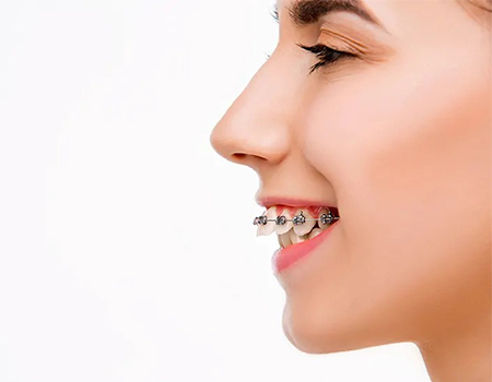 دیپ بایت به عنوان اپن بایت قدامی نیز شناخته می شود دیپ بایت, درمان دیپ بایت دندان, دیپ بایت به عنوان اپن بایت قدامی نیز شناخته می شود