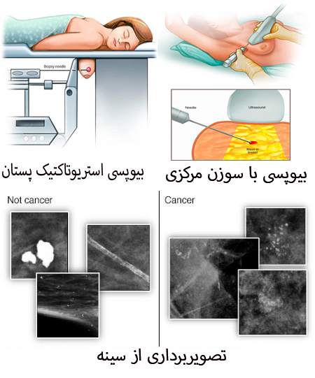راههای تشخیص کارسینوم داکتال درجا علل کارسینوم مجرای درجا, عوامل خطر کارسینوم مجرای درجا, راههای درمان کارسینوم مجرای درجا