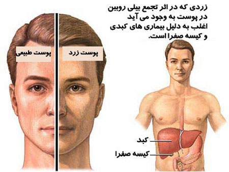 پیشگیری از زردی,بیماری های کبدی پیشگیری از زردی,بیماری های کبدی