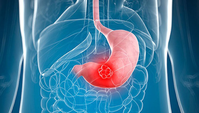 علائم سرطان معده چیست, علائم اولیه سرطان معده