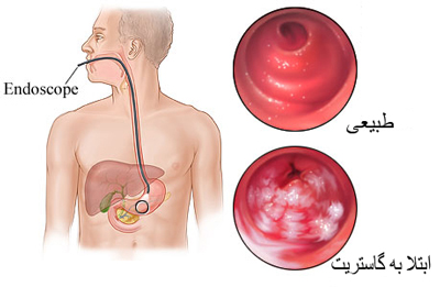 درمان گاستریت معده، حالت تهوع و نفخ در گاستریت علایم التهاب در معده, بیماری کرون