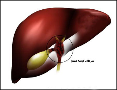 علائم سرطان کیسه صفرا, درمان سرطان کیسه صفرا