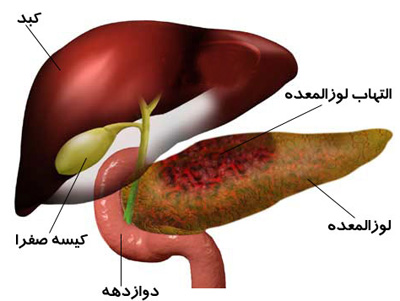 علائم سرطان کیسه صفرا, درمان سرطان کیسه صفرا