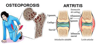 پوکی استخوان چیست, علائم پوکی استخوان