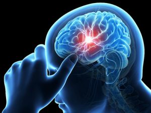علایم سکته مغزی, علائم سکته مغزی