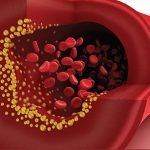 علائم نشان دهنده چربی خون, علائم چربی بالا