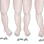علت پای پرانتزی, علل پای پرانتزی