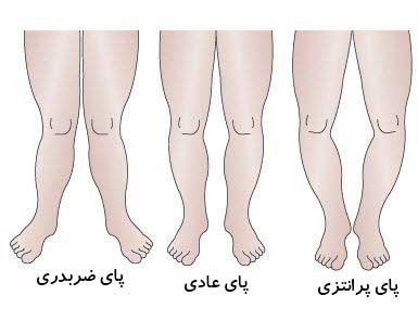 تغذیه کودکان,پا پرانتزی در کودکان,پا ضربدری در کودکان