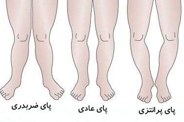 پای پرانتزی در کودکان،علت پای پرانتزی علت پای پرانتزی, علل پای پرانتزی