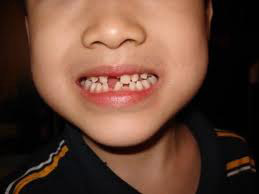 فتادن و رویش دندان های شیری