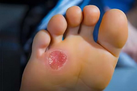 علت زخم پای دیابتی در کودکان, زخم پای دیابتی در کودکان, بیماری دیابت در کودکان