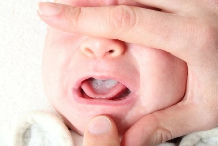 برفک نوک سینه, پماد برای برفک نوک سینه, پماد کلوتریمازول برفک نوک سینه
