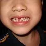 فتادن و رویش دندان های شیری