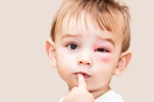 وقتی زنبور کودک را نیش می‌زند,نیش زنبور در کودکان,نیش زنبور در کودکان و نحوه درمان