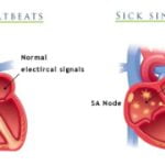 سندرم سینوس بیمار, نشانه های سندرم سینوس بیمار