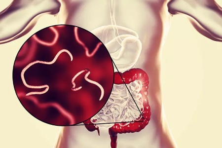 خارش مقعدی کودکان چیست