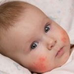علائم آلرژی غذایی در نوزادان