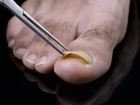 افتادن ناخن پا, سیاه شدن و افتادن ناخن پا