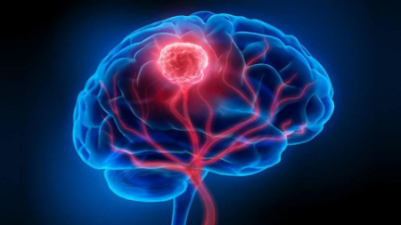 تشخیص گلیوما با استفاده از MRI و بیوپسی انجام میشود علائم تومور مغزی گلیوما, انواع تومور مغزی گلیوما