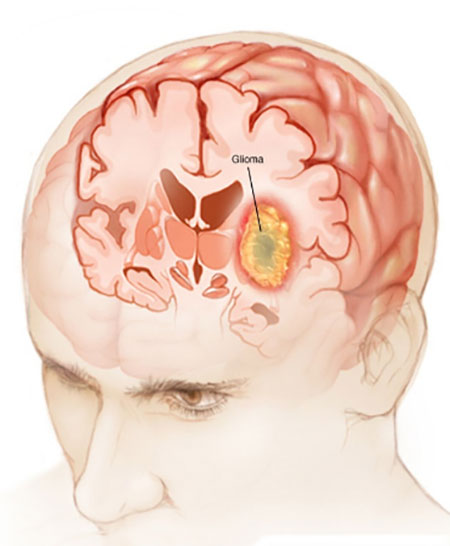 عوامل ژنتیکی میتوانند خطر ابتلا به گلیوما را افزایش دهند علائم تومور مغزی گلیوما, انواع تومور مغزی گلیوما