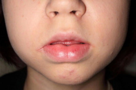 گرانولوماتوز دهانی صورت یک بیماری نادر است گرانولوماتوز دهانی صورت, درمان گرانولوماتوز دهانی
