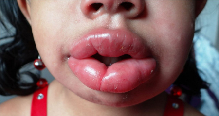 علت دقیق گرانولوماتوز دهانی صورت هنوز ناشناخته است گرانولوماتوز دهانی صورت, درمان گرانولوماتوز دهانی