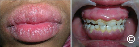 گرانولوماتوز دهانی صورت ممکن است به واکنش ایمنی یا آلرژی مرتبط باشد گرانولوماتوز دهانی صورت, درمان گرانولوماتوز دهانی
