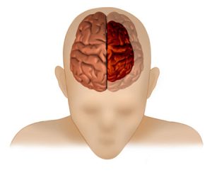 آتروفی مغز, بیماری آتروفی مغز