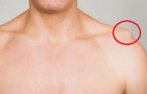 توده روی شانه, کیست شانه