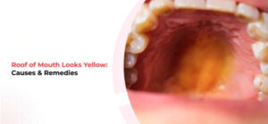 زرد شدن سقف دهان, علت زردی دهان