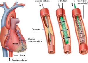 کاتتریزاسیون قلبی, کاتتر قلبی چیست